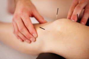 accupuncture-knee-needles-arthritis